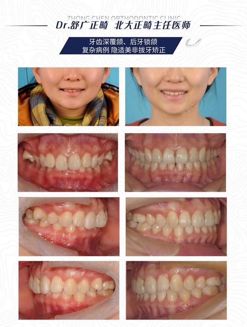 牙齿矫正后咬合太深，是什么原因导致的？该如何有效处理？-图1