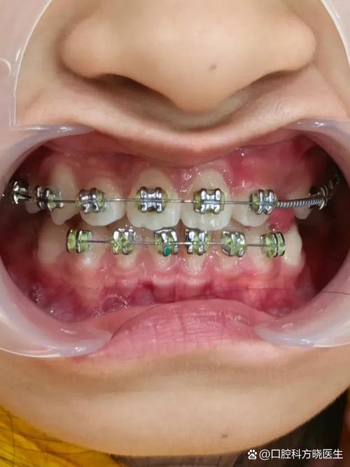 牙齿矫正后咬合太深，是什么原因导致的？该如何有效处理？-图3