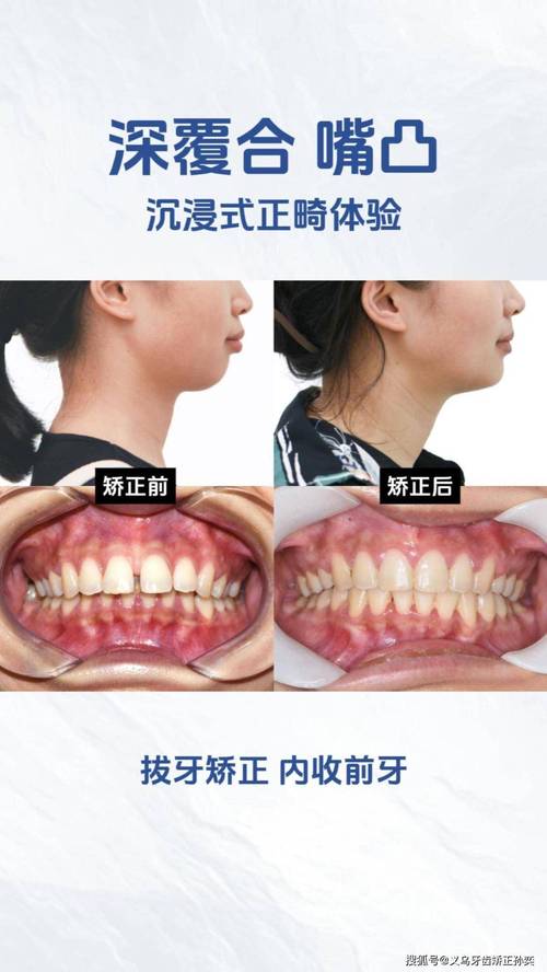 牙齿矫正后咬合太深，是什么原因导致的？该如何有效处理？-图2