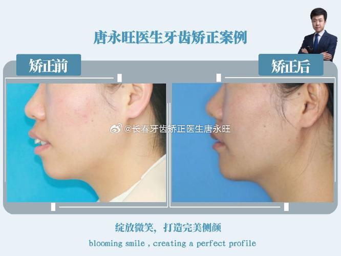 矫正牙齿保守治疗适用哪些情况？效果如何？-图1