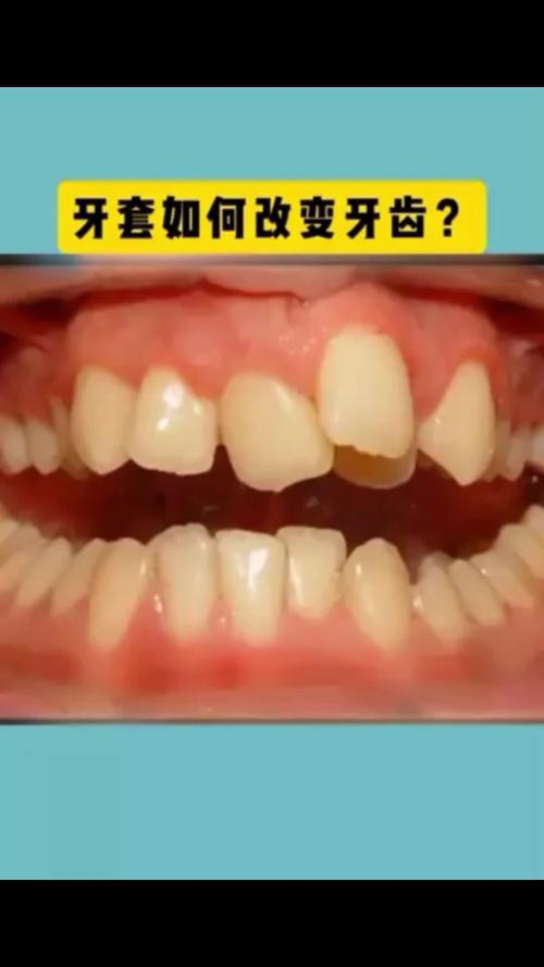 深圳牙齿矫正如何选择靠谱方法与机构?-图2 深圳牙齿矫正如何选择靠谱方法与机构?-图2