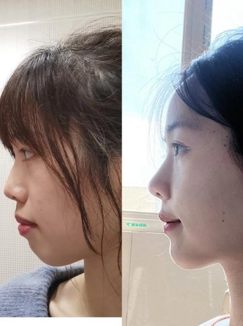 矫正牙齿前后侧面变化有多大?-图3 矫正牙齿前后侧面变化有多大?-图3