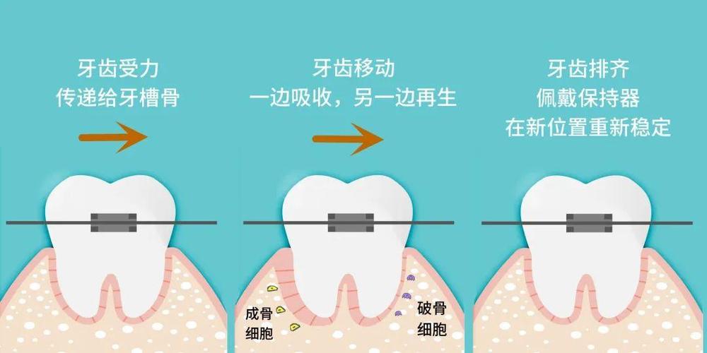 儿童矫正牙齿的原理是什么？家长需了解的关键点-图1