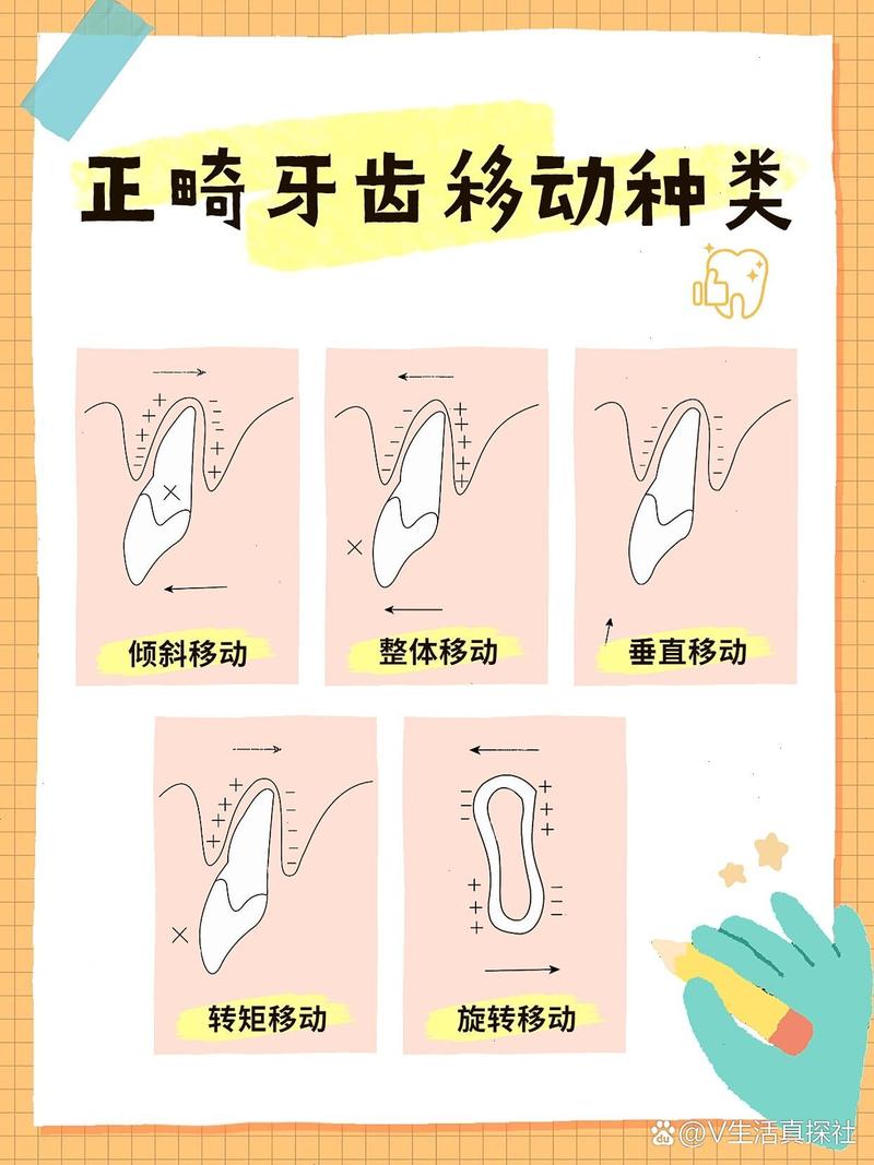 矫正中牙齿移动遵循哪些核心规律？-图1