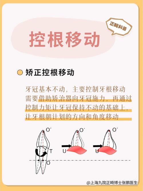 矫正中牙齿移动遵循哪些核心规律？-图2
