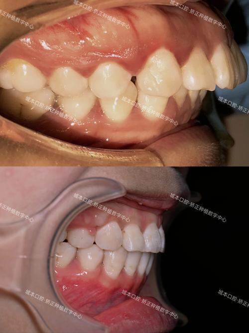 牙齿矫正类型案例怎么选？哪种更适合自己？-图3
