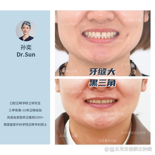 牙齿矫正类型案例怎么选？哪种更适合自己？-图2