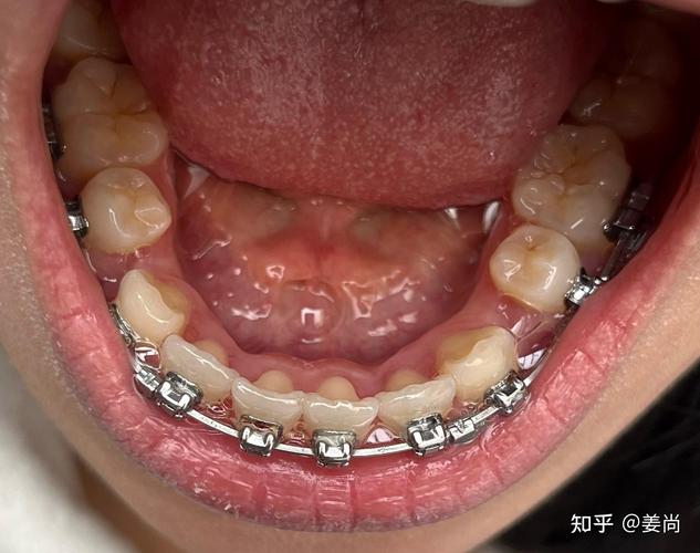 成都牙科矫正牙齿，效果好不好价格贵不贵怎么选？-图2