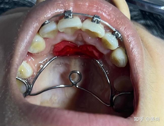 成都牙科矫正牙齿，效果好不好价格贵不贵怎么选？-图1