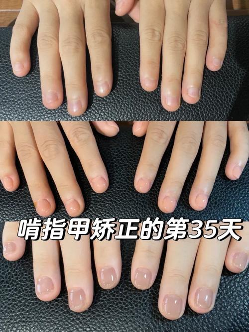 冰晶矫正牙齿效果如何？安全舒适吗？-图2