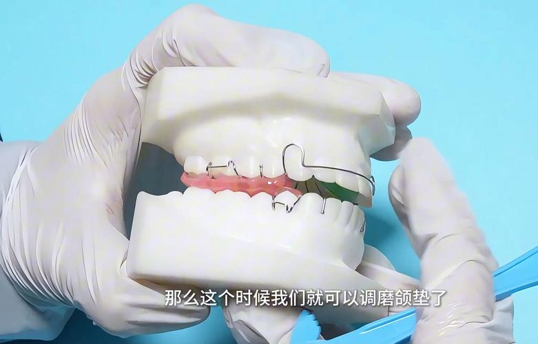 矫正牙齿加力太大,会导致牙齿松动吗?-图3 矫正牙齿加力太大,会导致牙齿松动吗?-图3