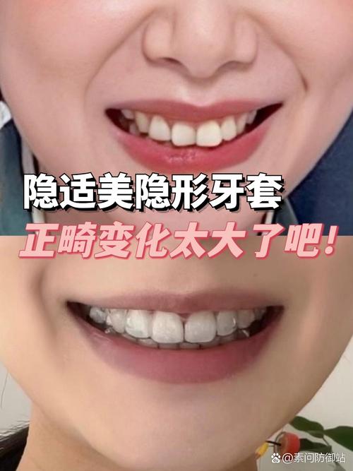 隐形牙齿矫正适合哪些人群？适用条件有哪些？-图3