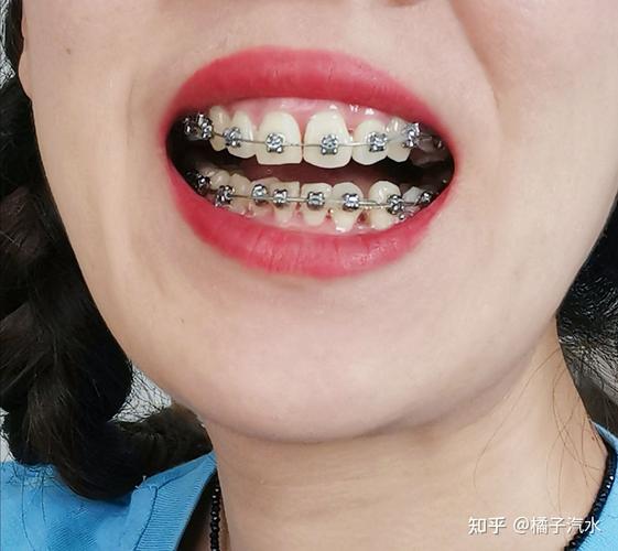 矫正牙齿取了虎牙-图2