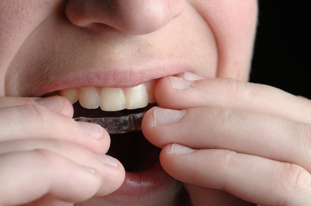 隐形矫正牙齿透明-图3