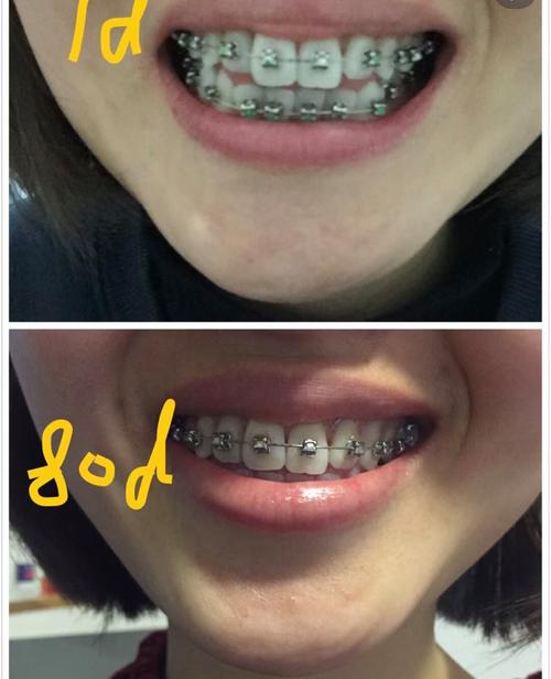 兔子牙矫正有哪些方法？效果能维持多久？-图2