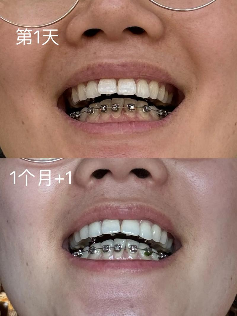 广州牙齿钢丝矫正效果如何?需要多久见效?-图3 广州牙齿钢丝矫正效果如何?需要多久见效?-图3