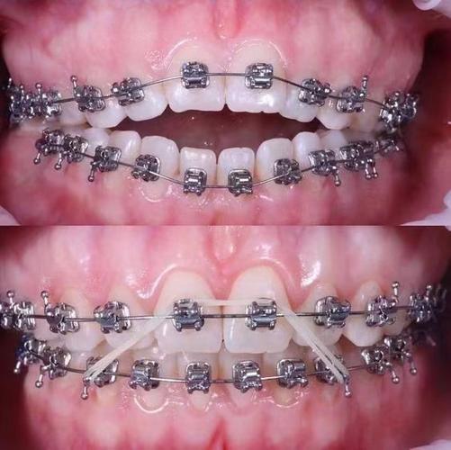 钢丝矫正牙齿前期，需做哪些准备及避免哪些事项？-图1