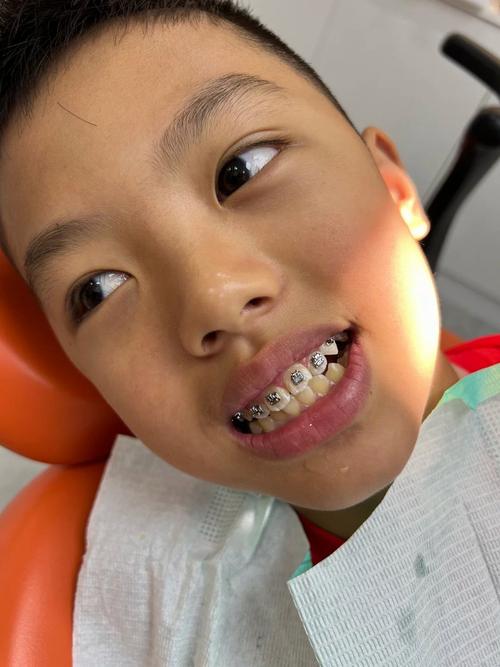 苏州小孩矫正牙齿,最佳年龄、方法及费用如何选?-图1 苏州小孩矫正牙齿,最佳年龄、方法及费用如何选?-图1