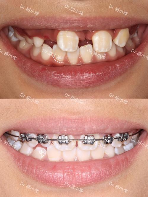 江苏矫正牙齿为何便宜？靠谱医院和避坑指南？-图3