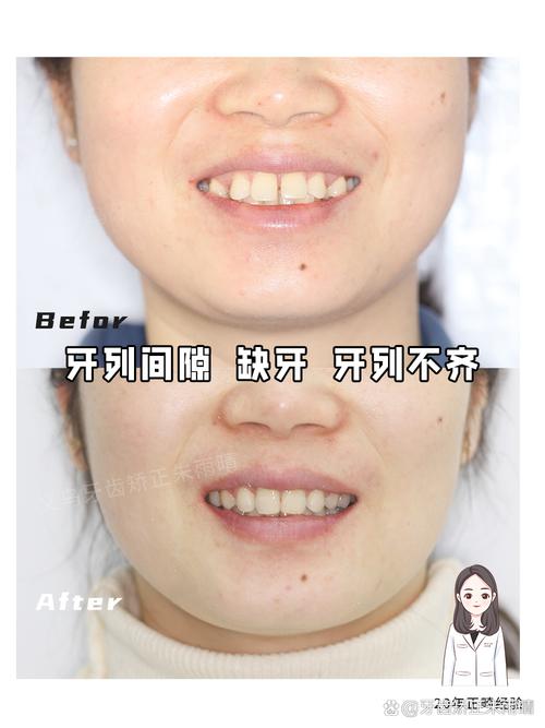 自己矫正牙齿不齐靠谱吗?效果和安全如何?-图2 自己矫正牙齿不齐靠谱吗?效果和安全如何?-图2