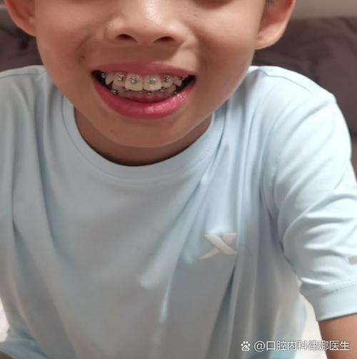 自己矫正牙齿不齐靠谱吗?效果和安全如何?-图3 自己矫正牙齿不齐靠谱吗?效果和安全如何?-图3