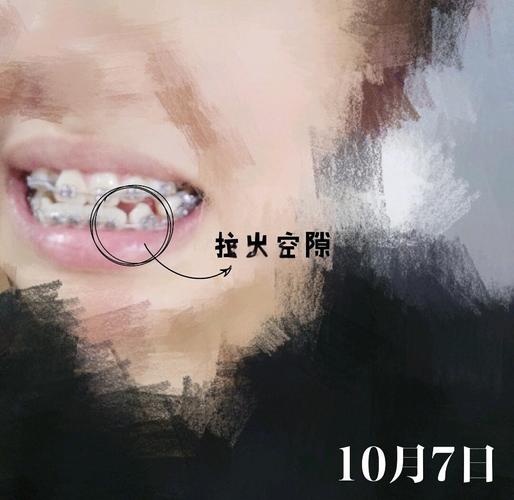 牙齿矫正弹簧牵引如何精准移动错位牙？-图1