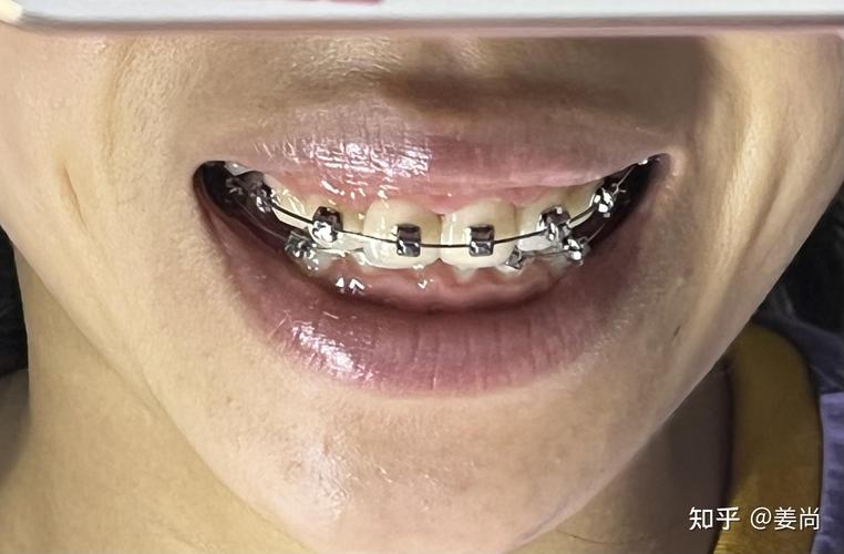 牙齿矫正医院快速矫正，效果和靠谱度如何？-图3