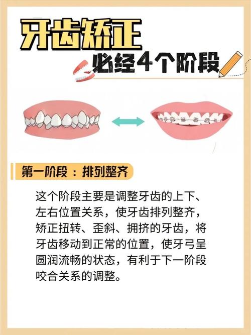 矫正牙齿胶圈用法-图2 矫正牙齿胶圈用法-图2