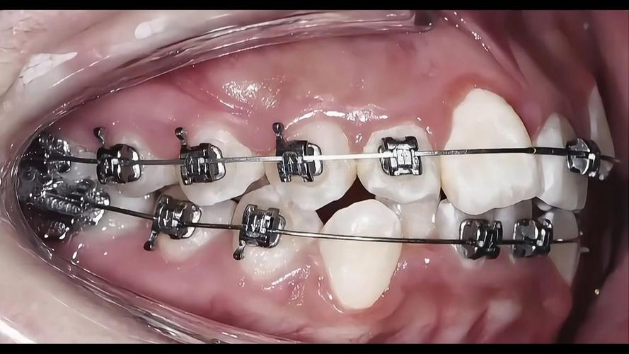 成人正畸矫正牙齿，年龄会影响矫正效果吗？-图2