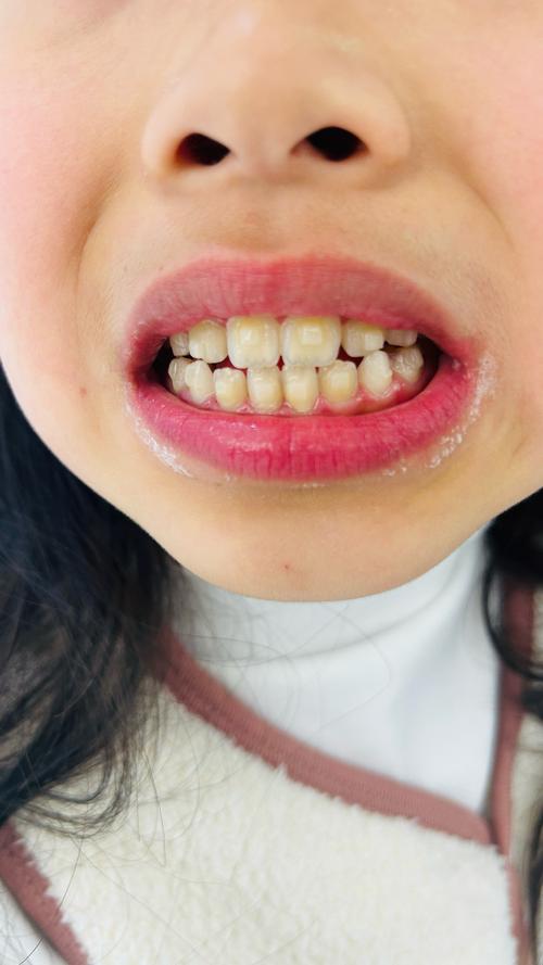 南昌小孩矫正牙齿，到底几岁开始效果最好？-图2