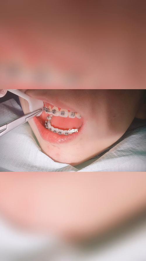 衡水哪家矫正牙齿-图3 衡水哪家矫正牙齿-图3