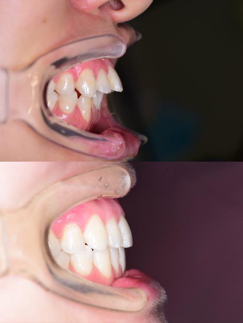 矫正牙齿后牙缝总塞牙？原因和应对方法-图1