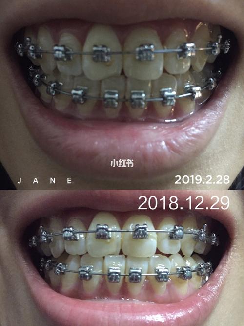 矫正牙齿钢丝变化-图1