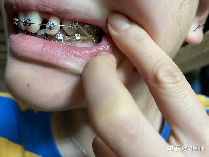矫正牙齿钢丝变化-图3