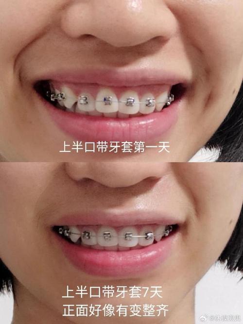 沈阳哪有矫正牙齿-图1