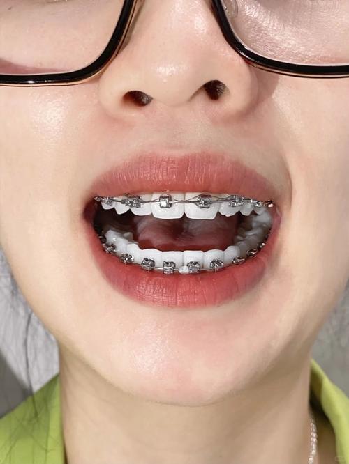 沧州口腔牙齿矫正效果如何？哪家更靠谱价格透明？-图1