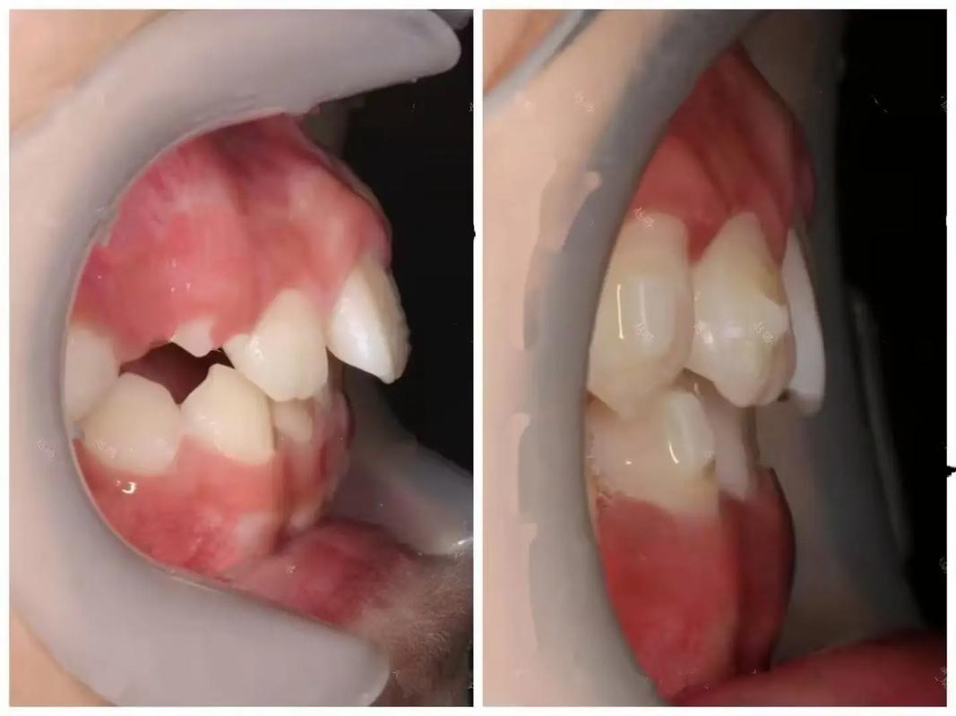 矫正牙齿能改善面容外突的脸型问题吗？-图1