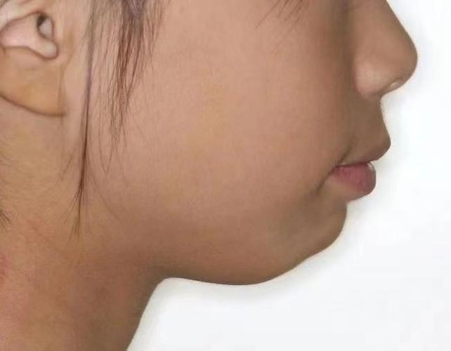矫正牙齿能改善面容外突的脸型问题吗？-图2