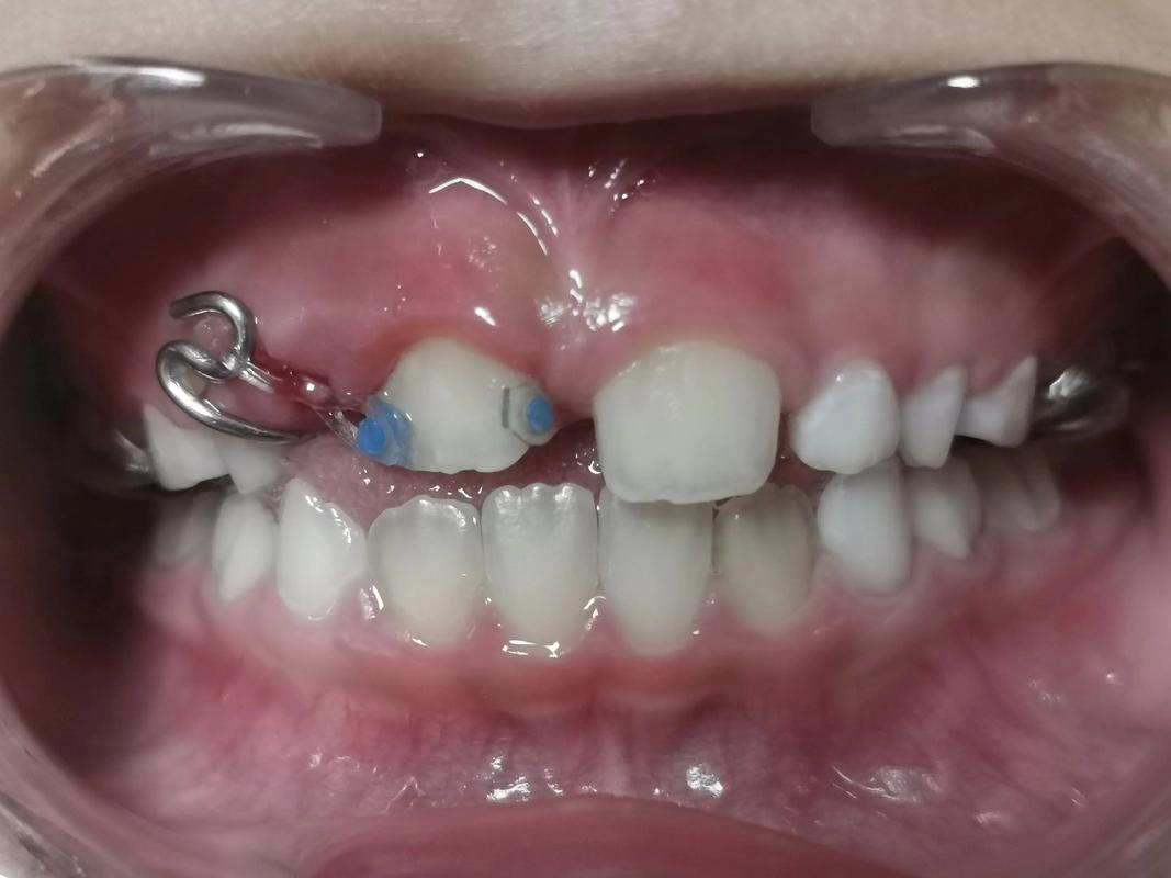 牙齿扭转矫正有哪些常用方法？-图1