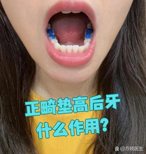 矫正牙齿抬高后牙-图1 矫正牙齿抬高后牙-图1