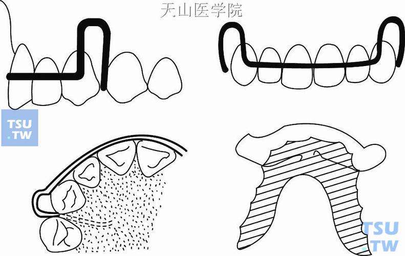 矫正牙齿唇弓制备的关键技术要点有哪些？-图2