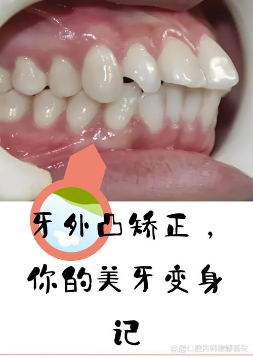 牙齿外凸矫正效果如何？过来人分享真实体验-图1