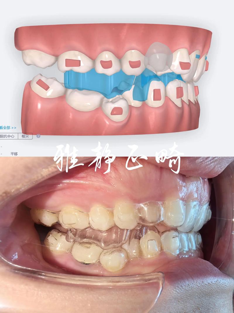 隐形矫正牙齿推荐，怎么选品牌才靠谱？-图1
