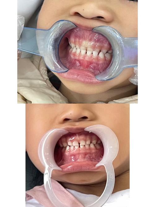 东莞小孩矫正牙齿，家长需关注哪些关键问题？-图1