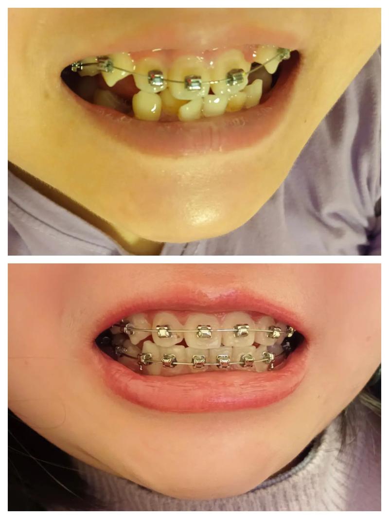 贵阳牙科矫正牙齿-图2