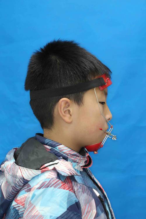 儿童矫正牙齿仪器真的适合孩子吗？效果和安全性如何？-图1
