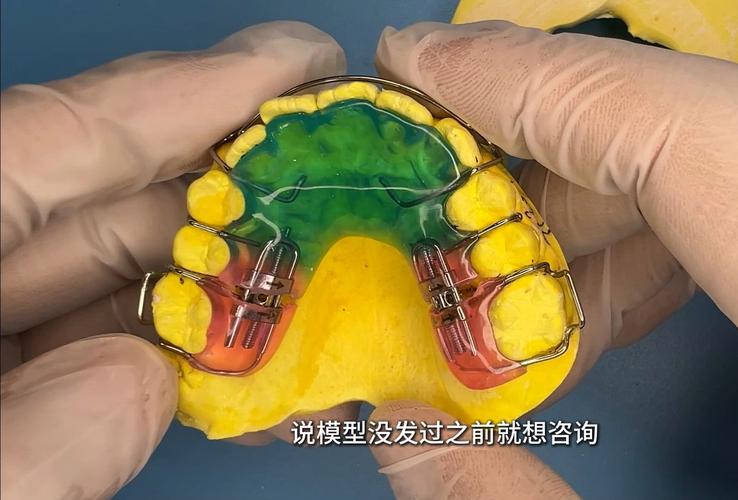 儿童矫正牙齿仪器真的适合孩子吗？效果和安全性如何？-图3