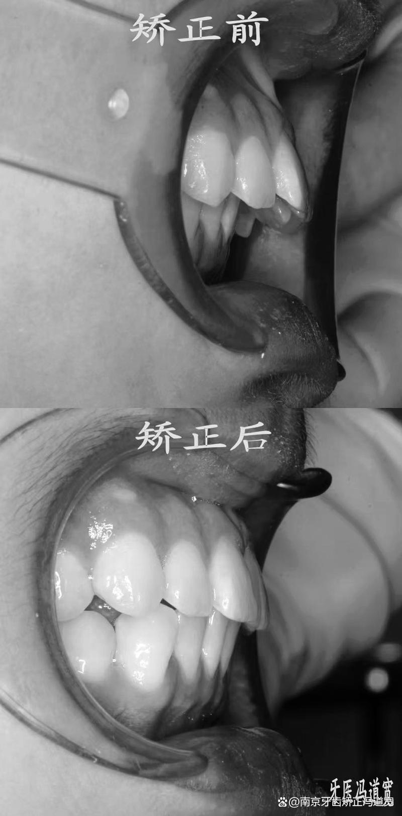 南京明星牙齿矫正为何成热门选择？效果和医生技术如何？-图1
