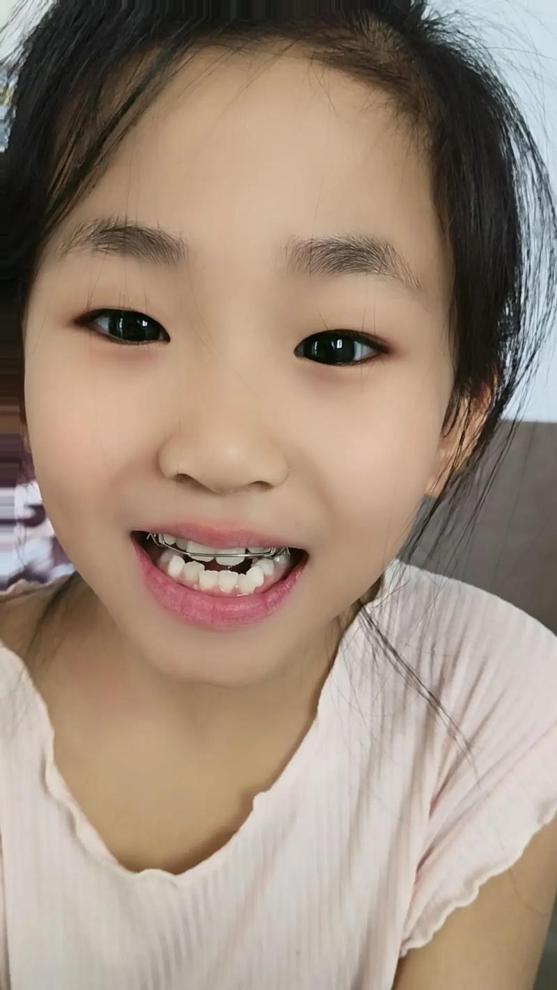 龙华附近牙齿矫正-图3