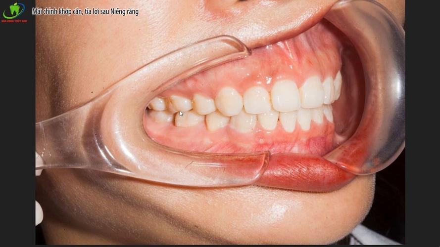 国外牙齿矫正公司为何受青睐？核心优势何在？-图2